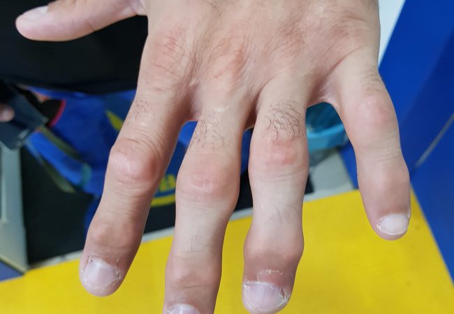 9 dicas para você lidar com as dores nos dedos após o Jiu-Jitsu